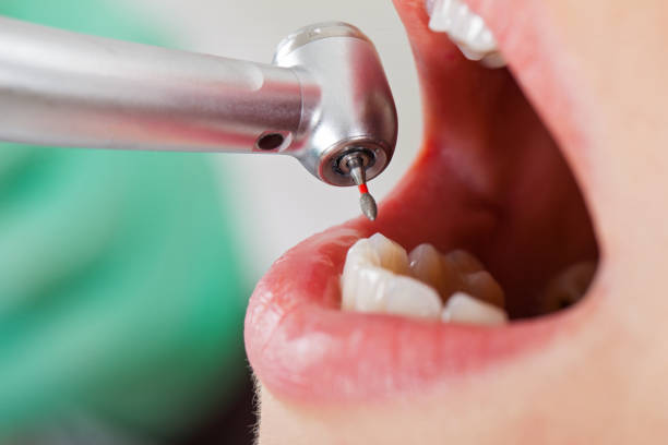 Best Emergency Dental Extractions in Munroe Falls, OH